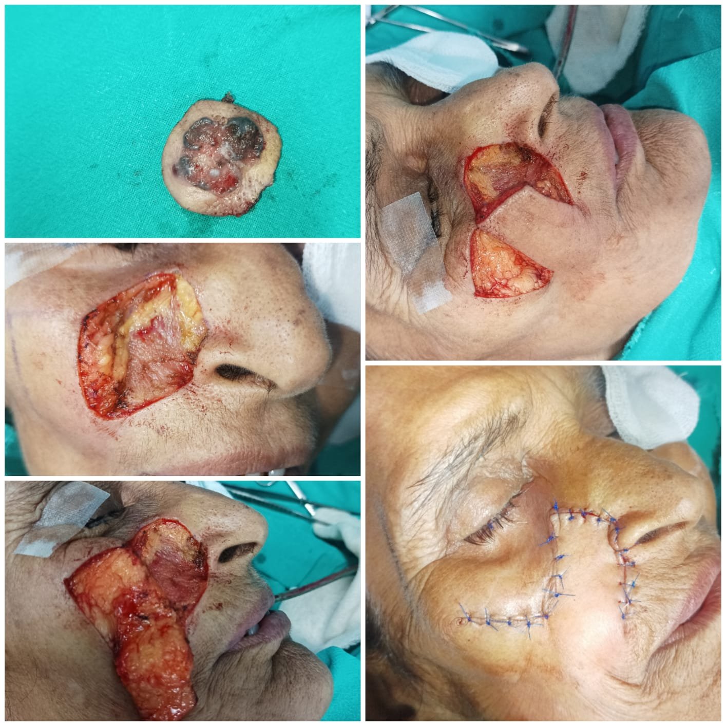Cheek cancer  before and after